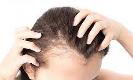 Hair Loss Treatment in AHmedabad